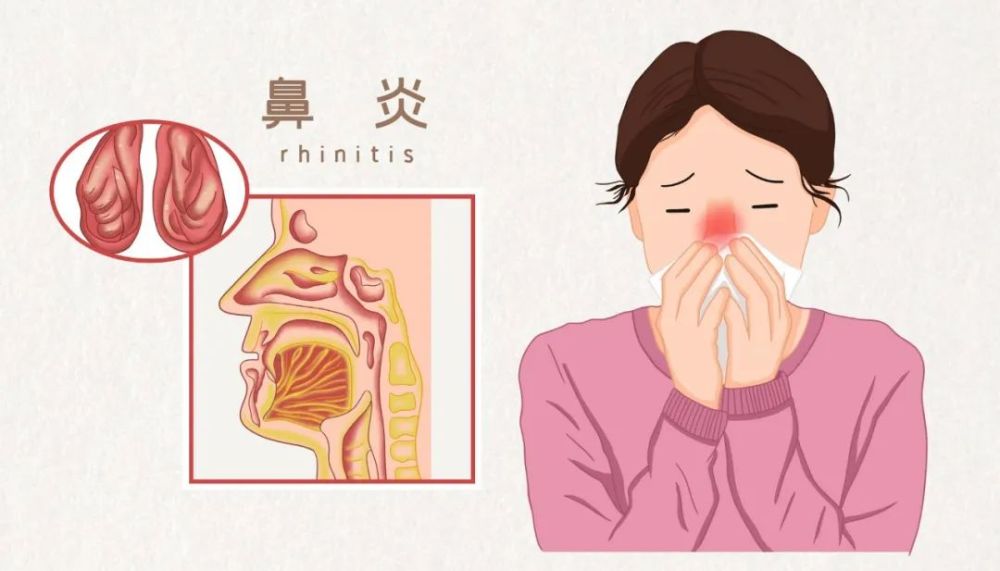 感冒后鼻塞喷嚏总不好？究竟是怎么了(图1)