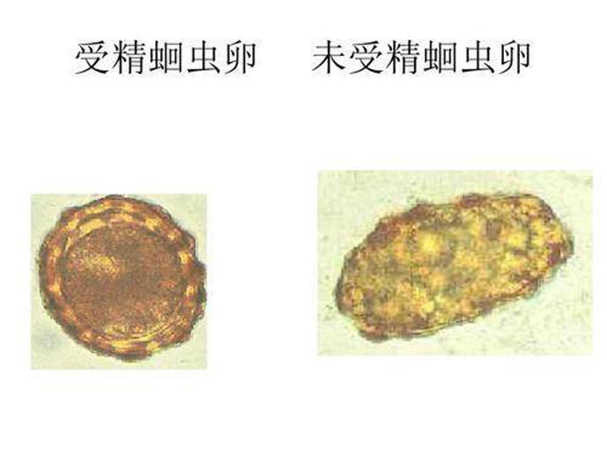 七八十年代，几乎每人肚里都生过蛔虫，为啥现在却没人感染蛔虫了(图7)