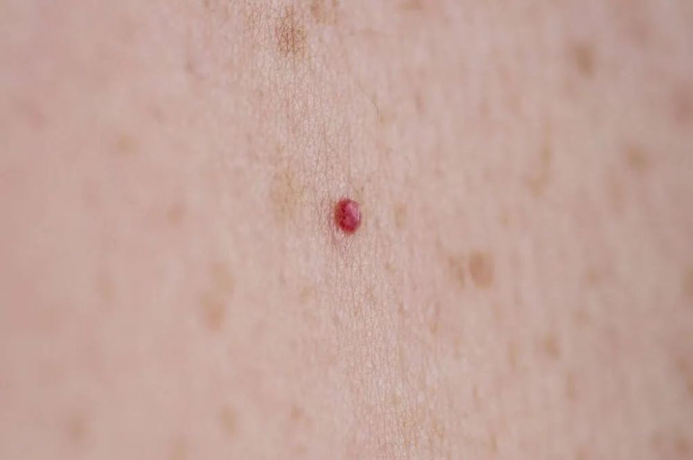 皮肤上长出的小红点，到底是什么？(图1)