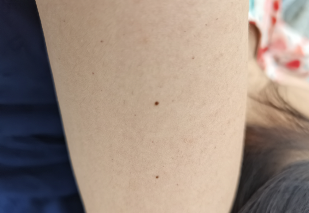 皮肤上长出的小红点，到底是什么？(图2)