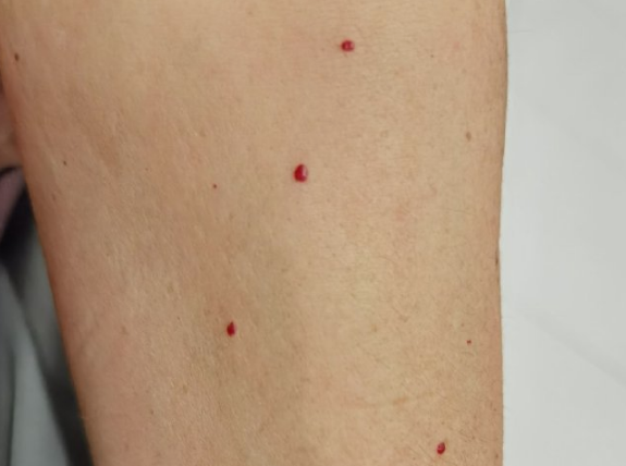 皮肤上长出的小红点，到底是什么？(图4)